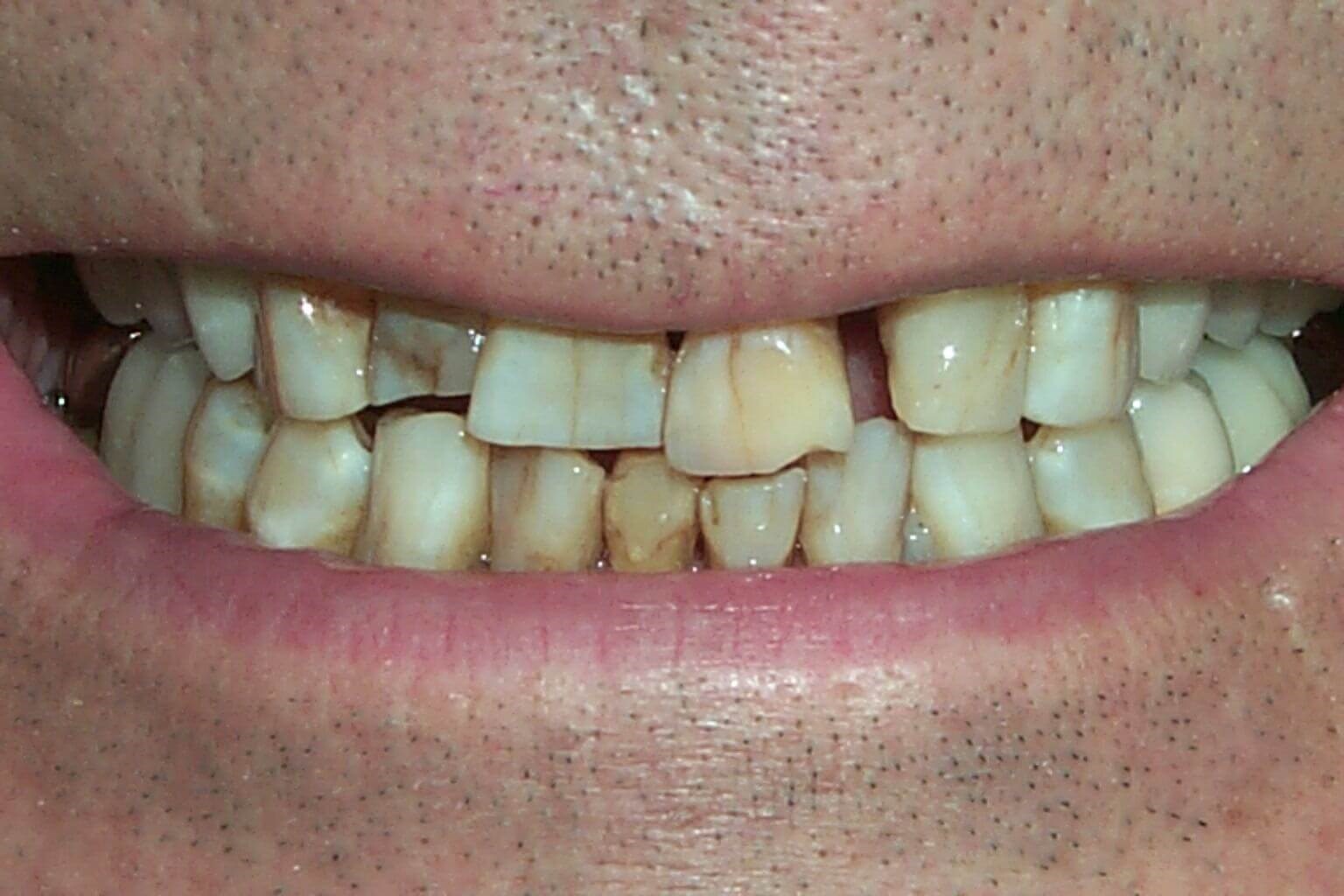 Smile Makeover Before Smile Makeover Before