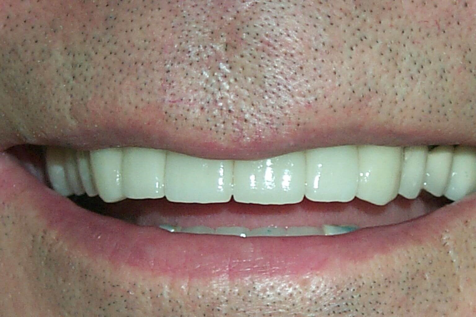 Smile Makeover After Smile Makeover After