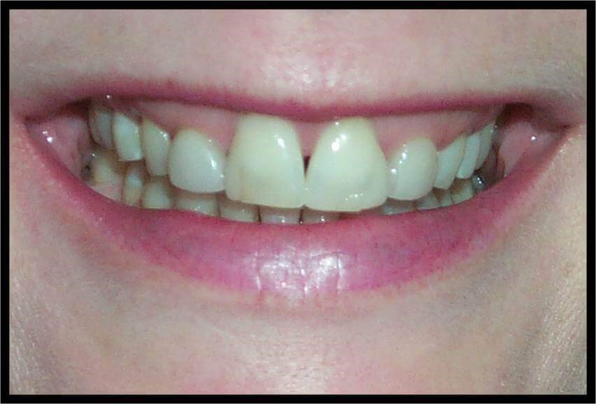 Anterior 360 Veneers Before Anterior 360 Veneers Before