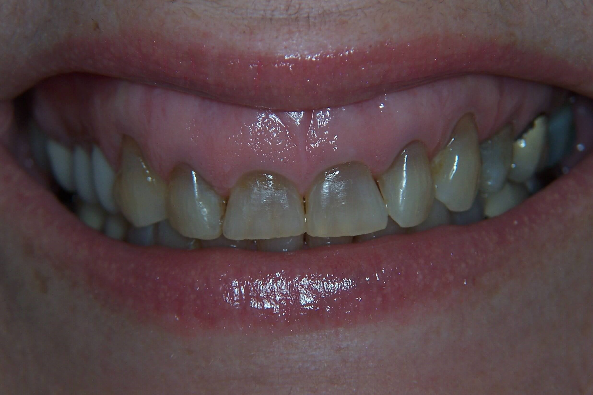 Anterior Aesthetic Makeover Before Anterior Aesthetic Makeover Before