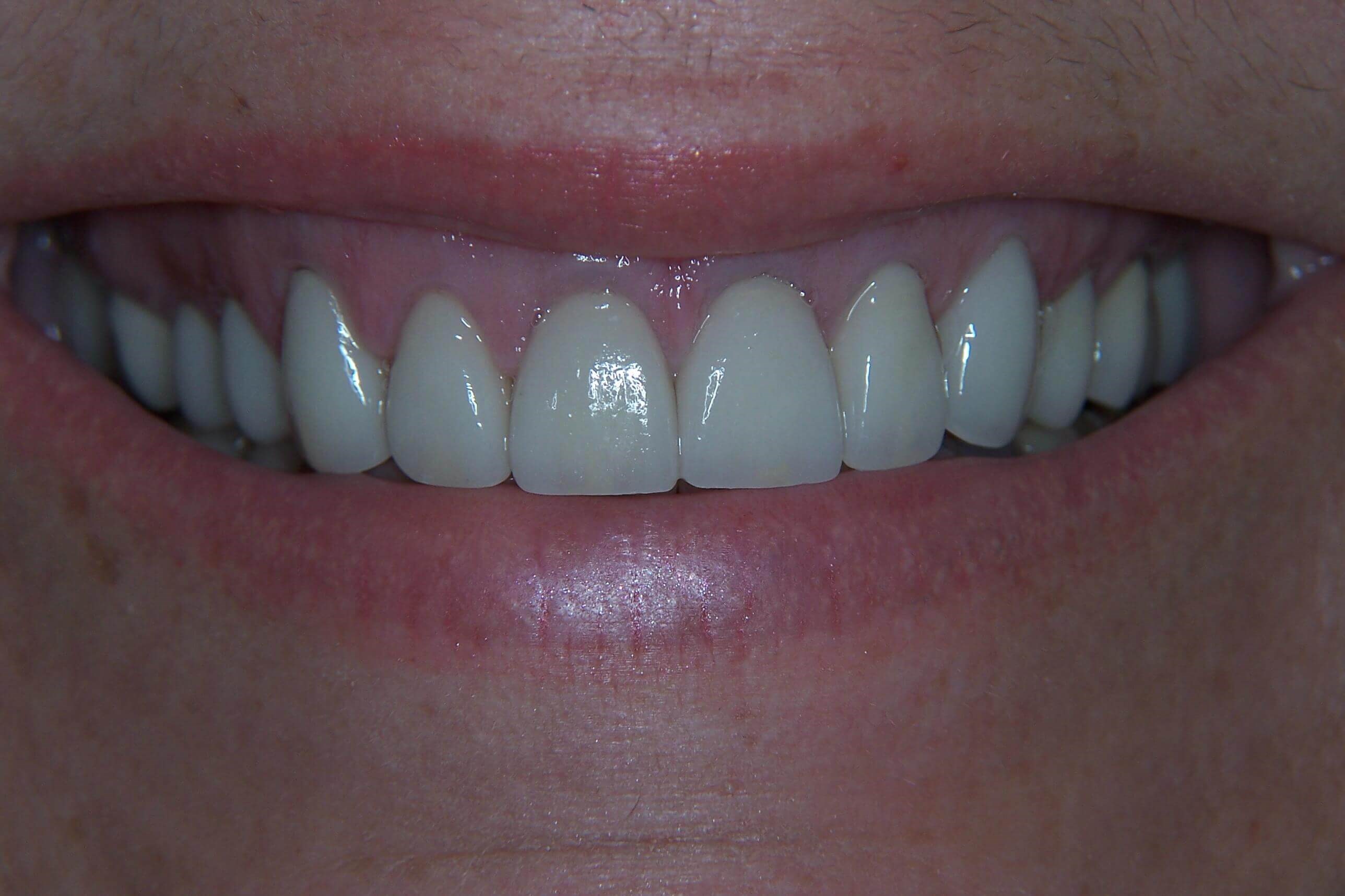 Anterior Aesthetic Makeover After Anterior Aesthetic Makeover After