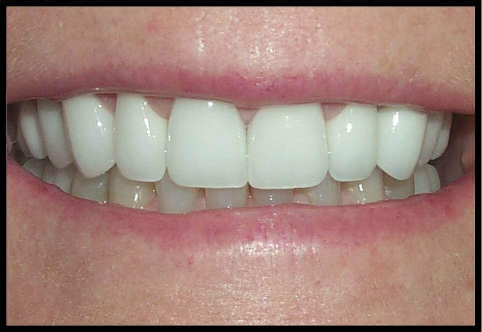 Implants and 360° Veneers After Implants and 360° Veneers After