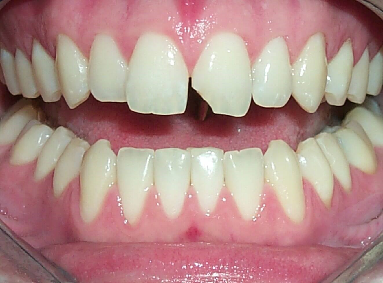 Anterior Bonding Before Anterior Bonding Before
