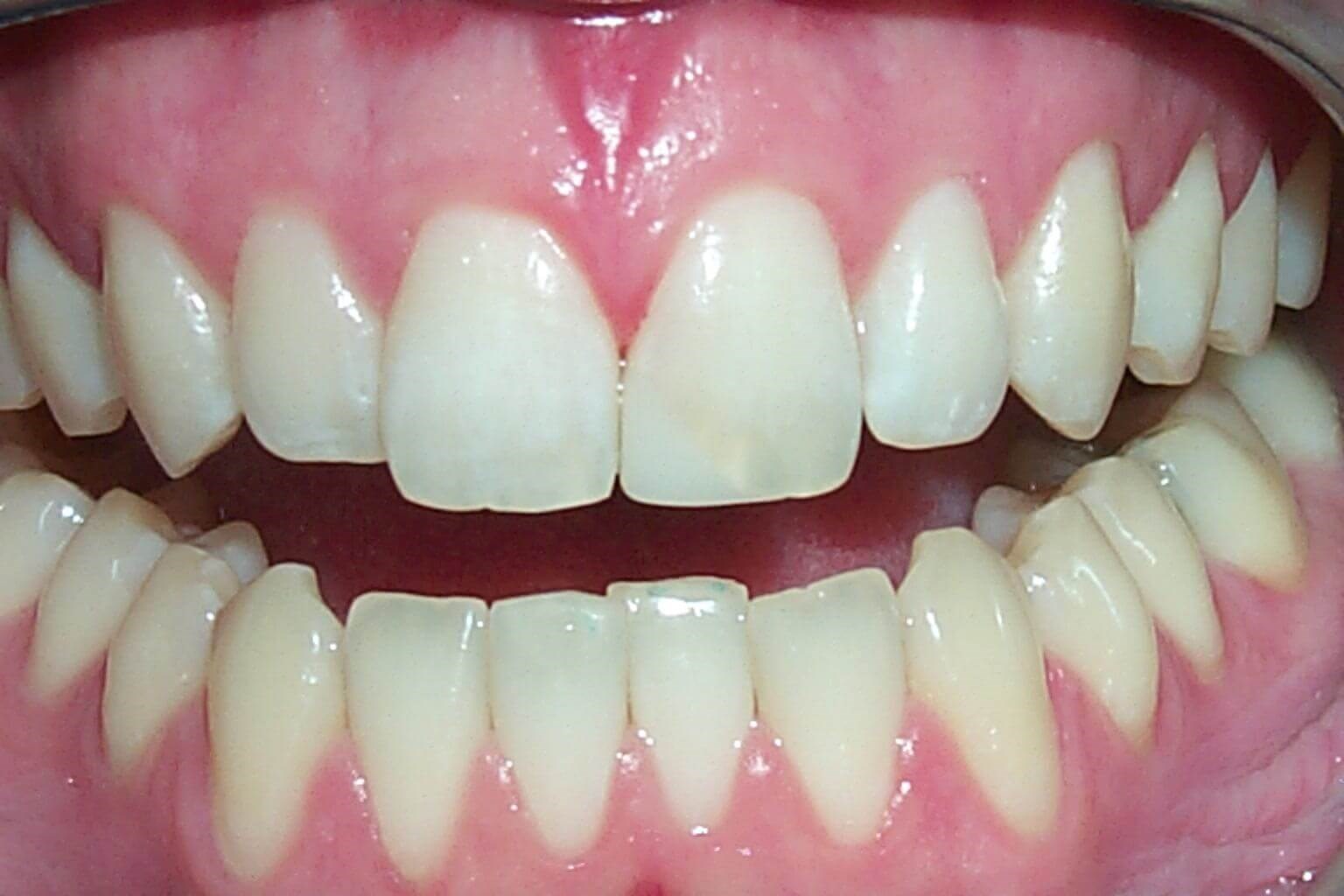 Anterior Bonding After Anterior Bonding After