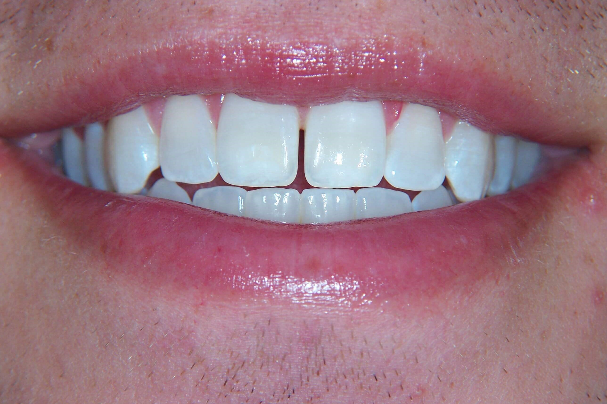 Anterior Diastema Before Anterior Diastema Before