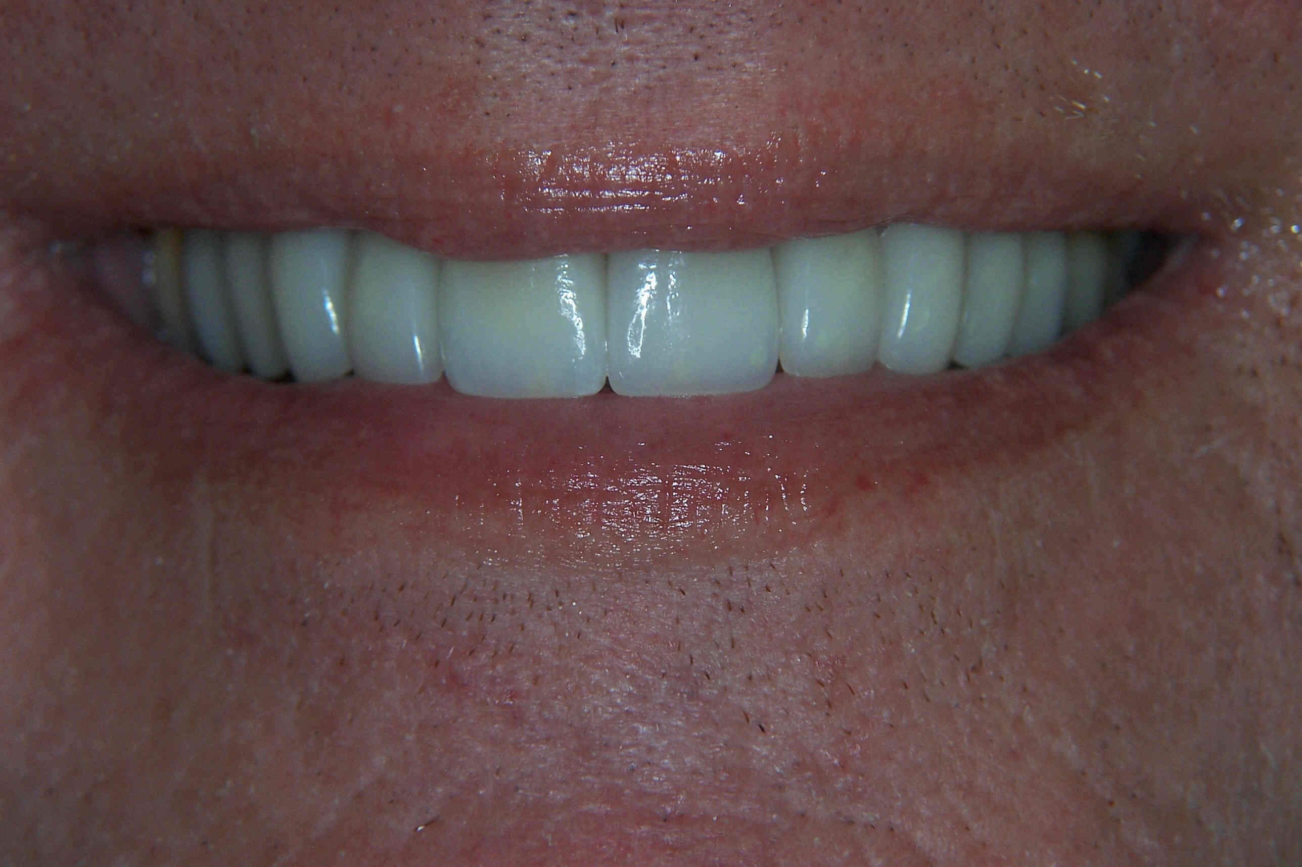 Smile Makeover After Smile Makeover After