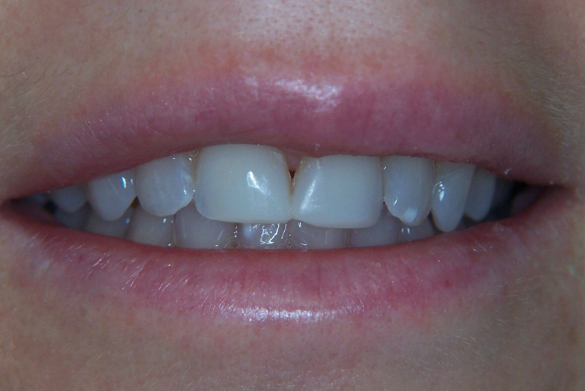 Anterior 360 Veneers Before Anterior 360 Veneers Before