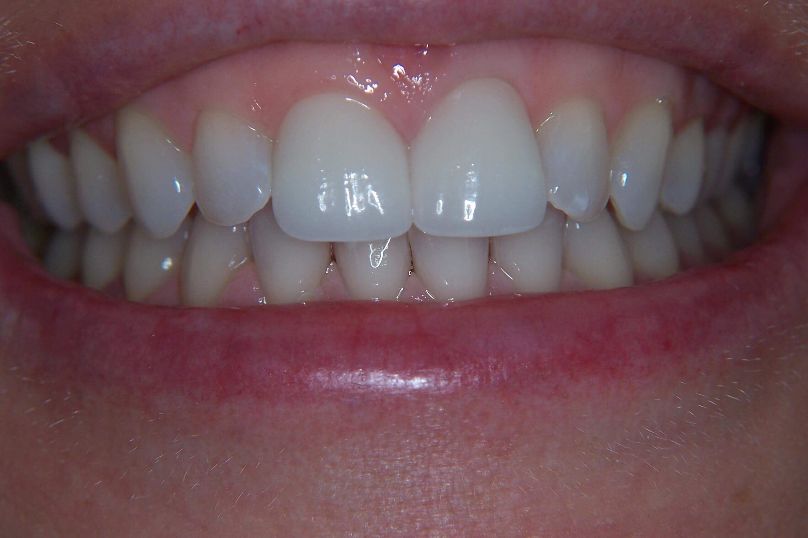 Anterior 360 Veneers After Anterior 360 Veneers After