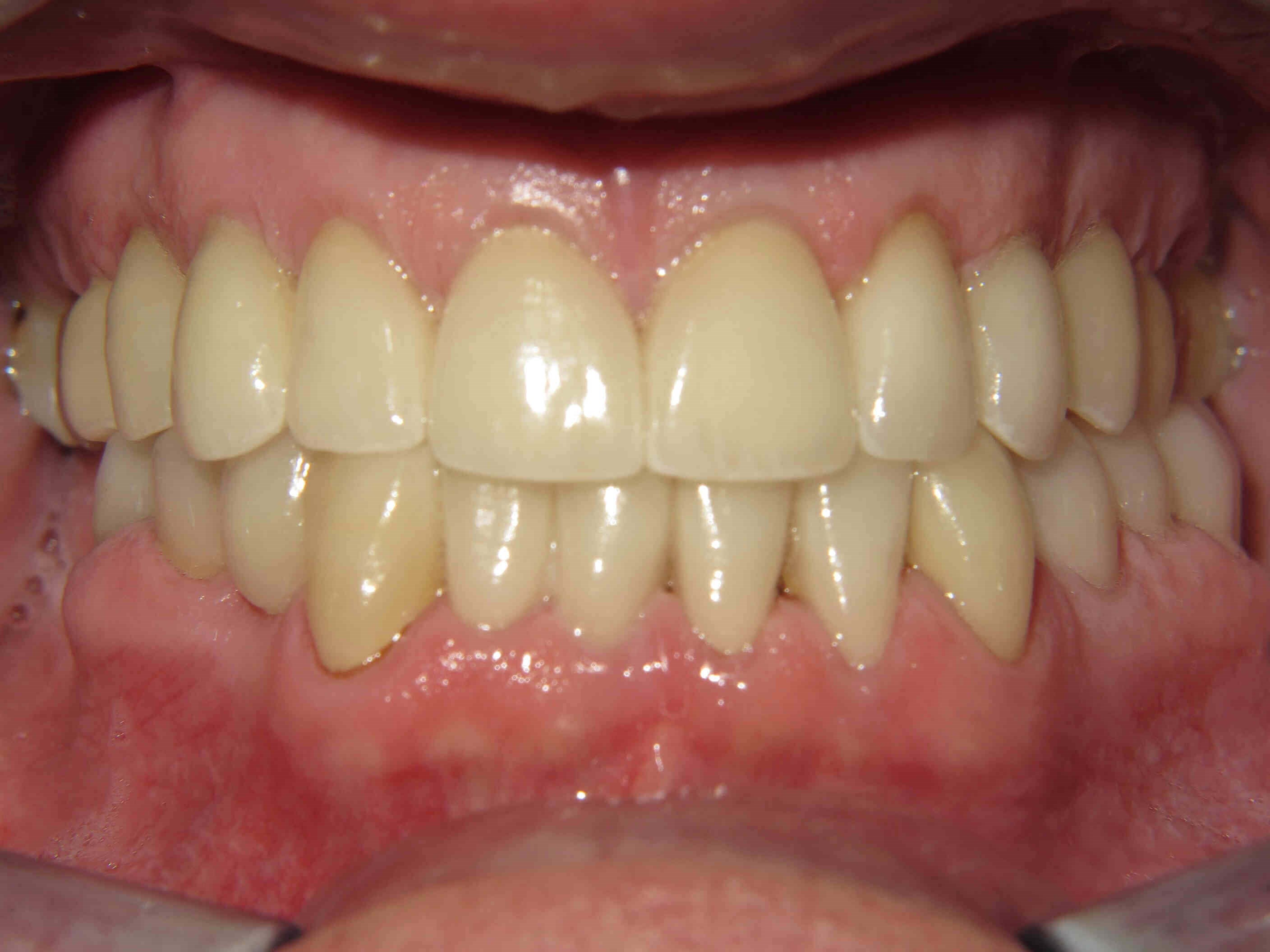 Smile Makeover After Smile Makeover After