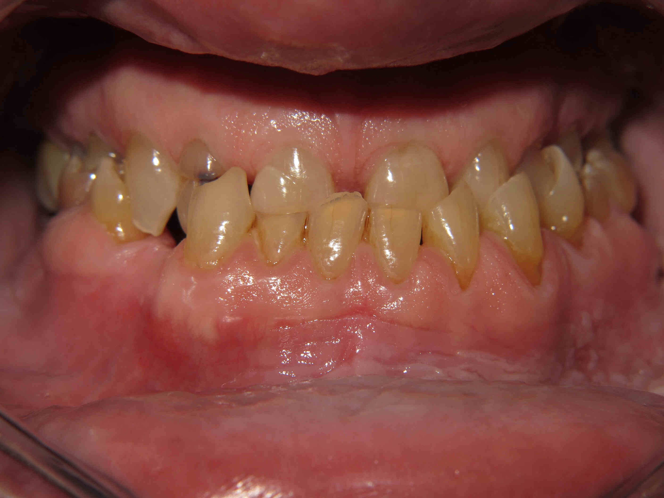 Smile Makeover Before Smile Makeover Before
