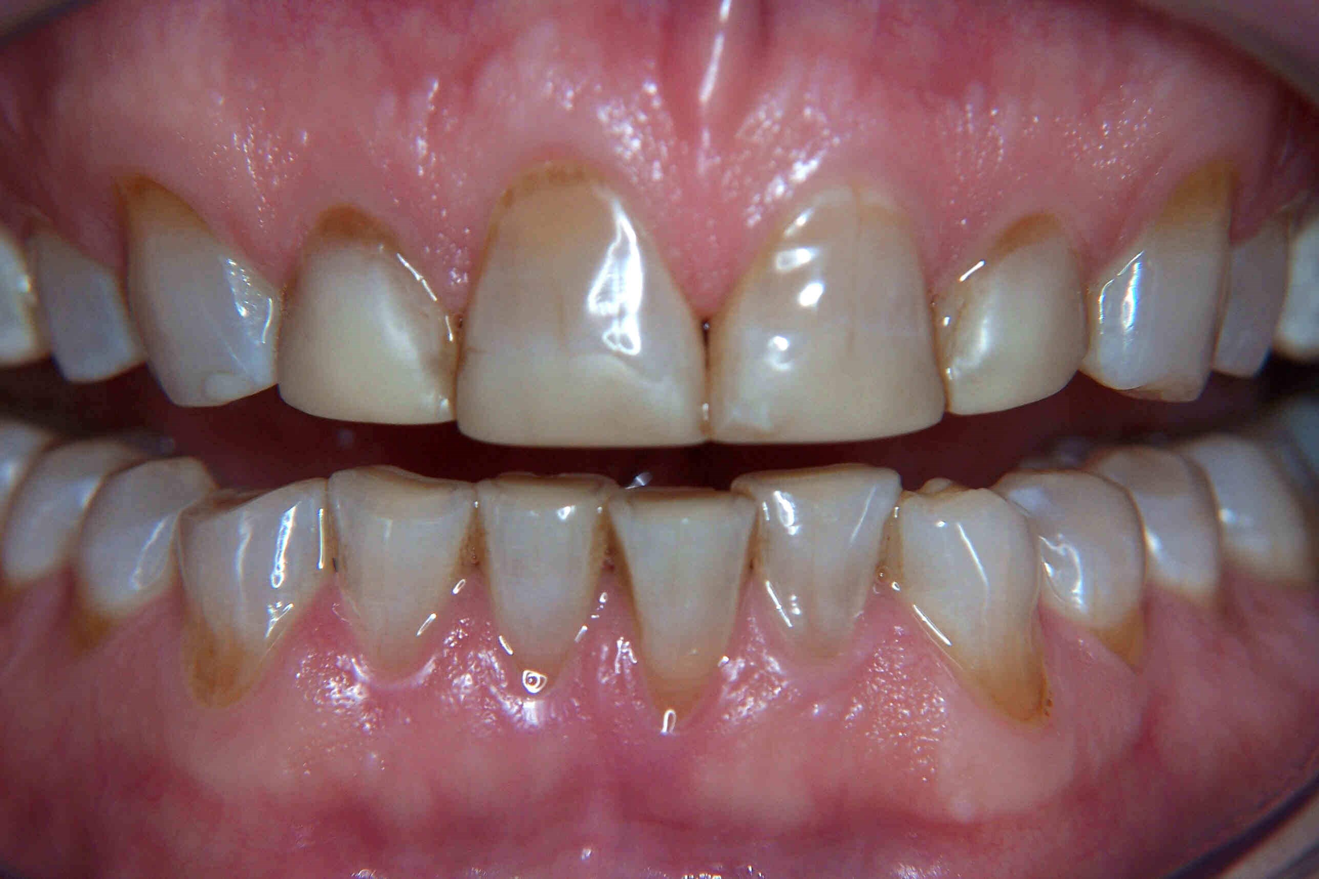 360 Veneers Before 360 Veneers Before