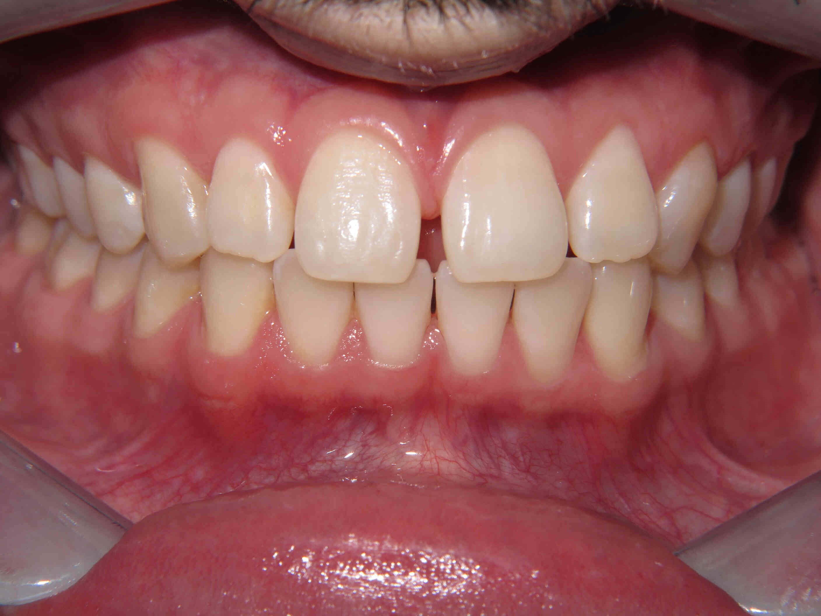 Clear Correct Aligners Before Clear Correct Aligners Before