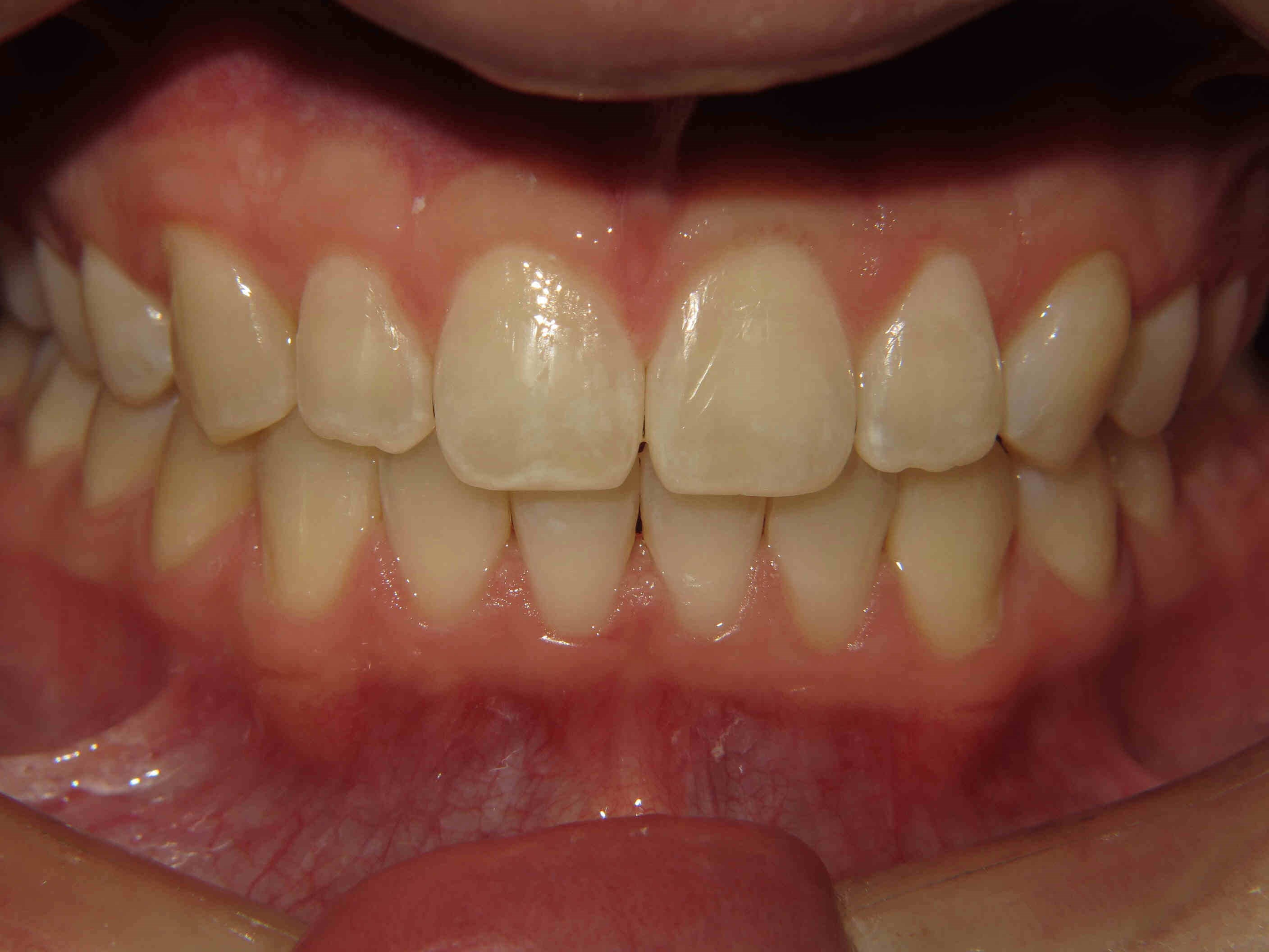 Clear Correct Aligners After Clear Correct Aligners After