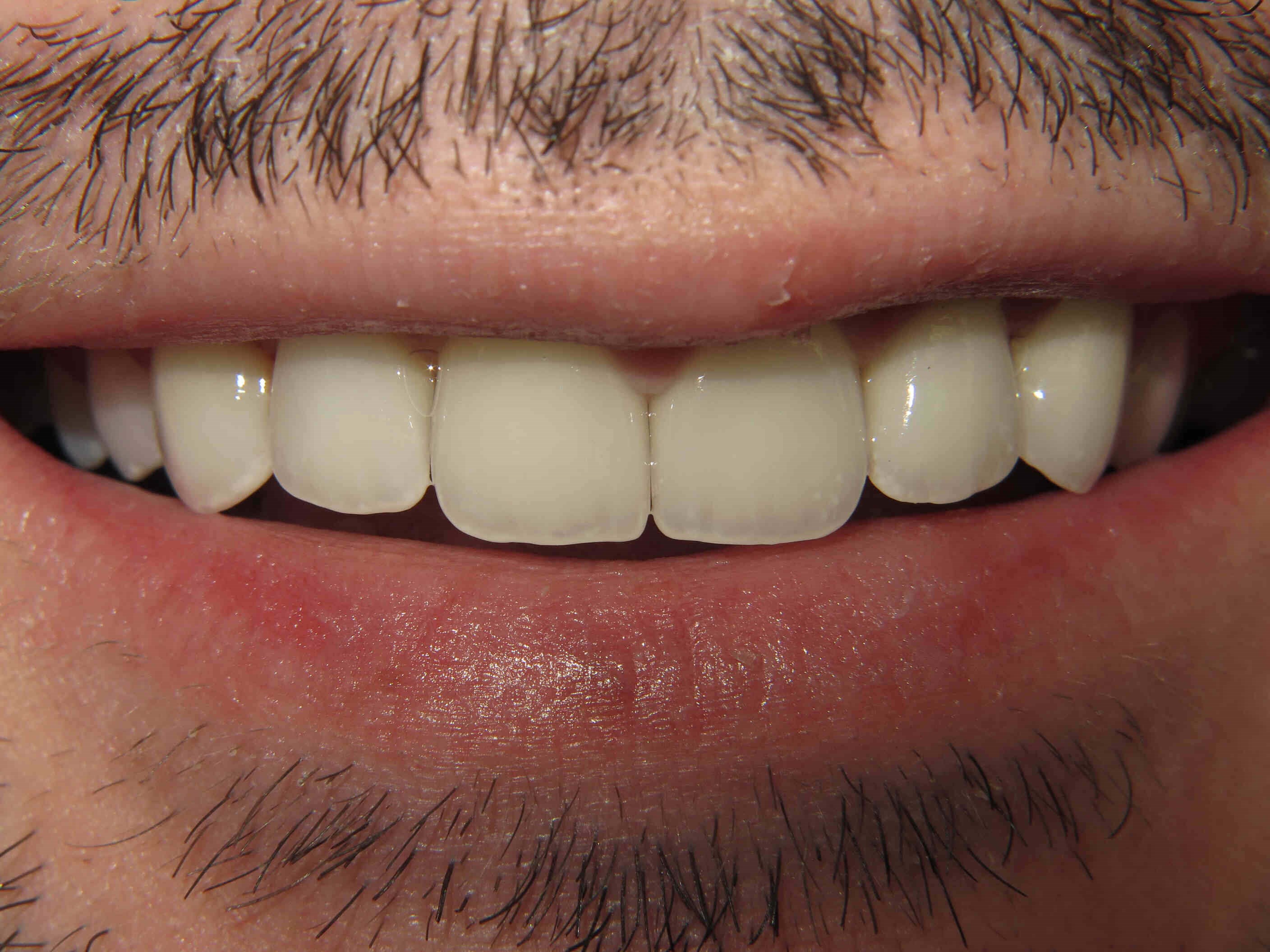 Smile Makeover After Smile Makeover After