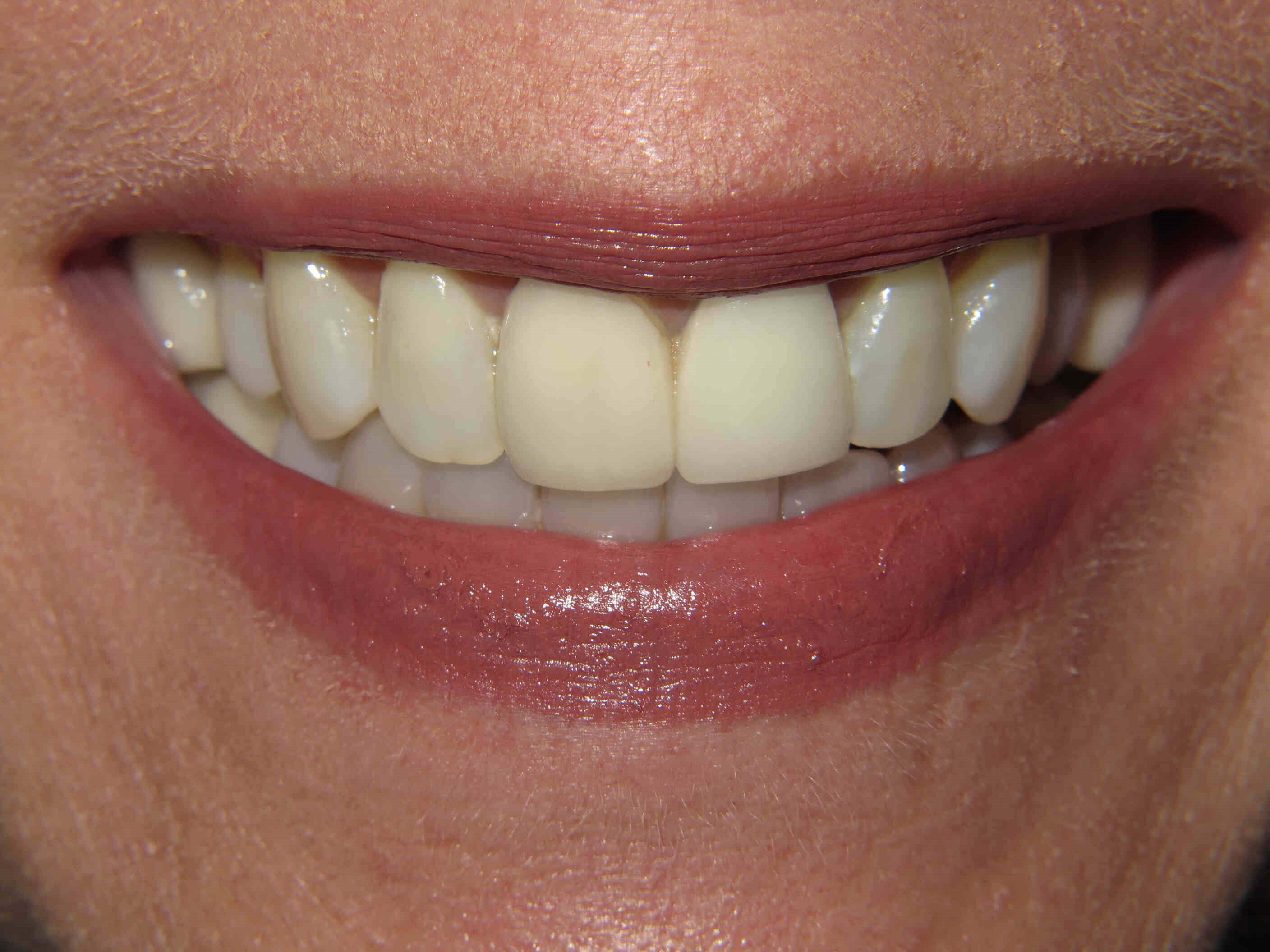 Smile Makeover Before Smile Makeover Before