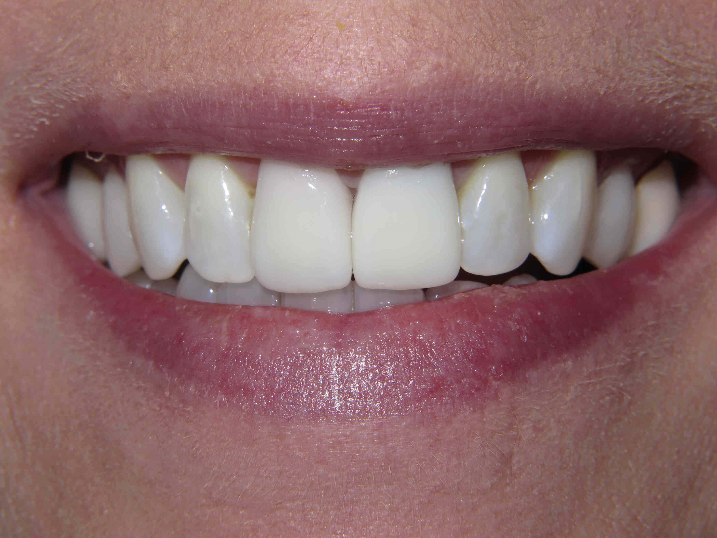 Smile Makeover After Smile Makeover After