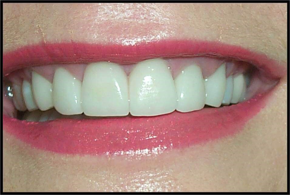 Anterior 360 Veneers After
