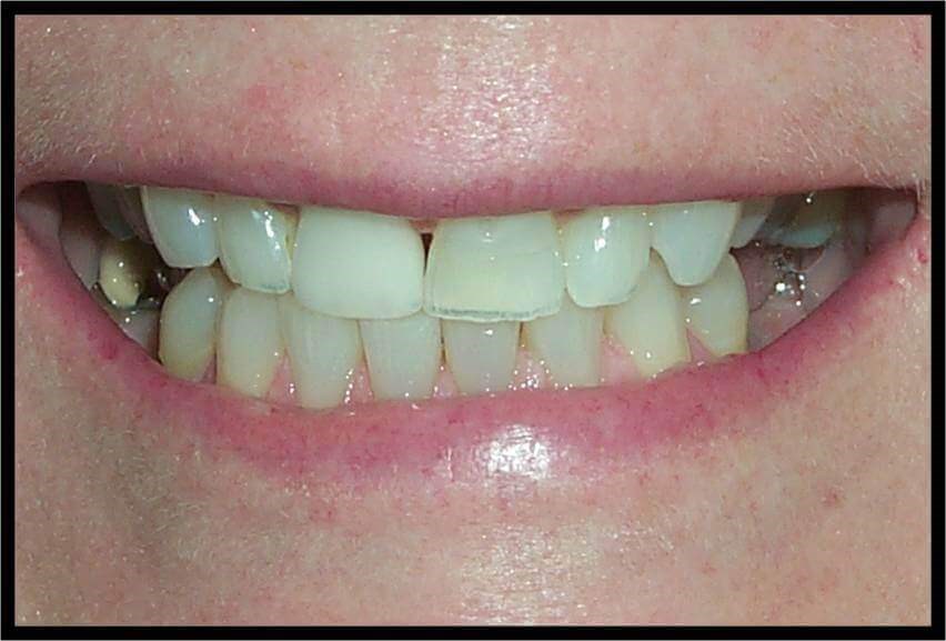 Implants and 360° Veneers Before