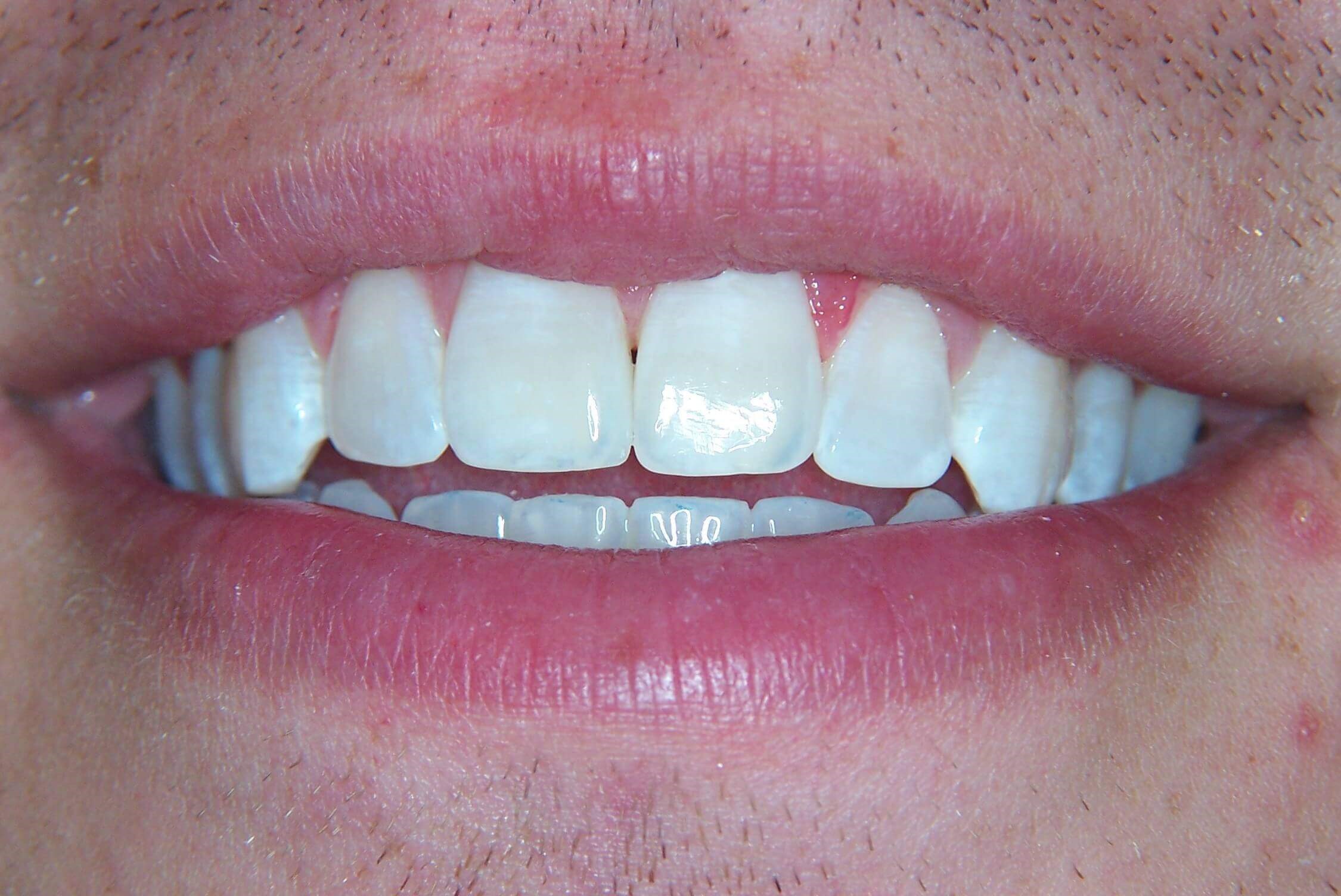 Anterior Diastema After