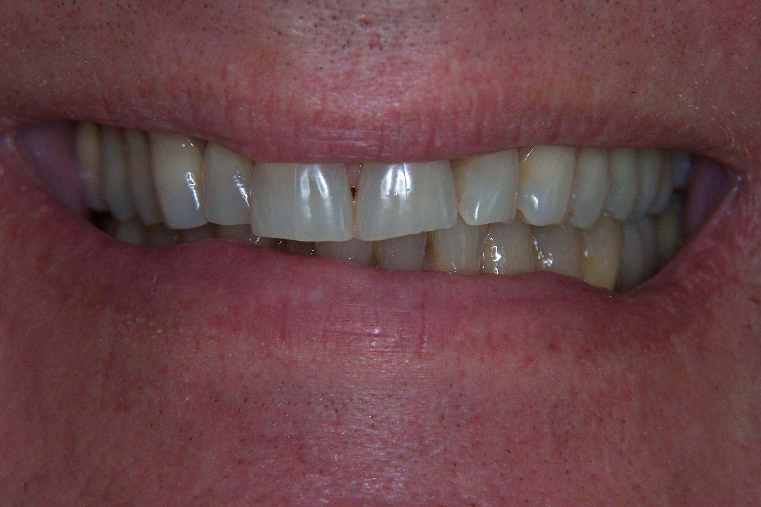 Smile Makeover Before