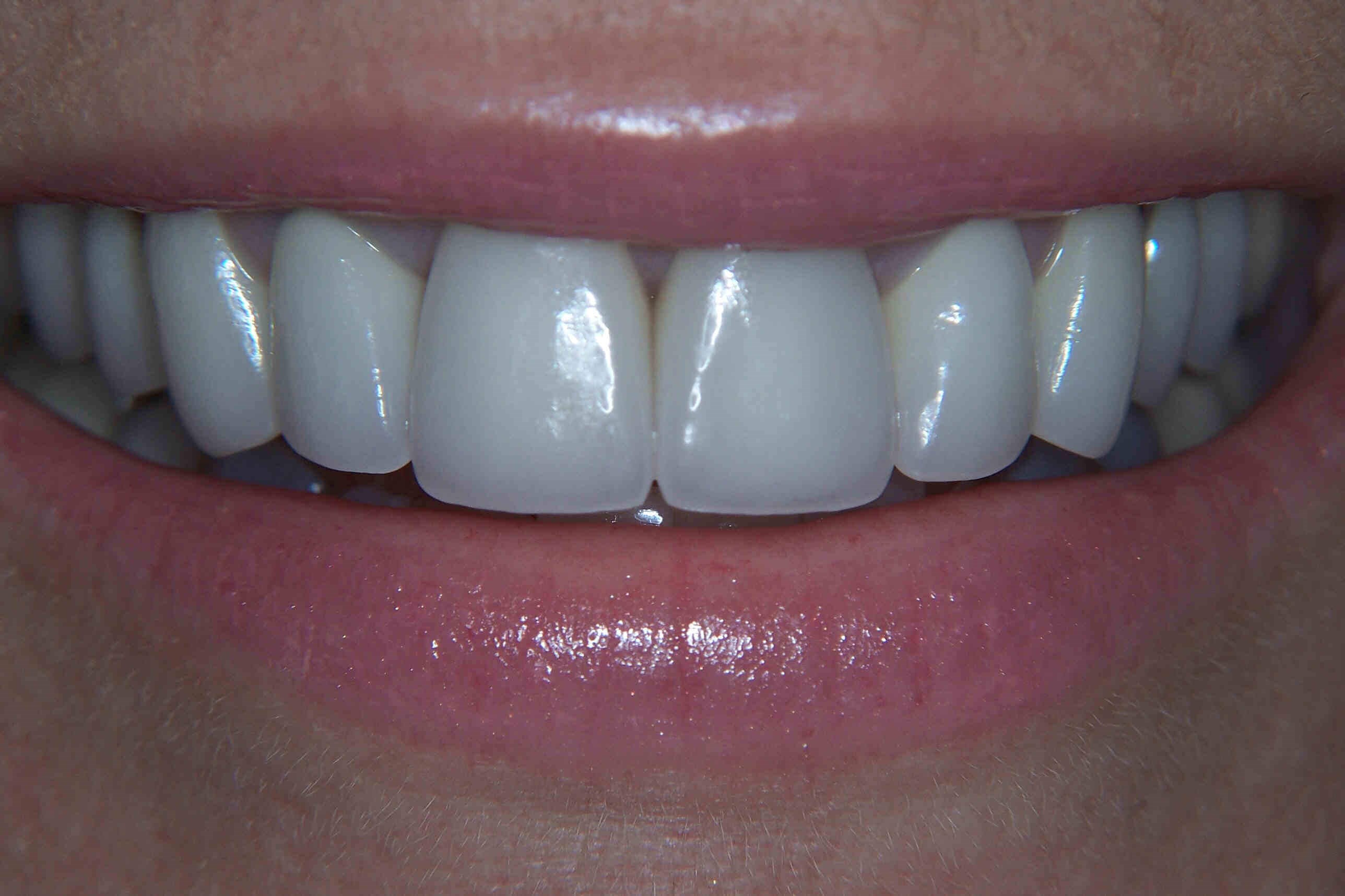 360 Veneers After