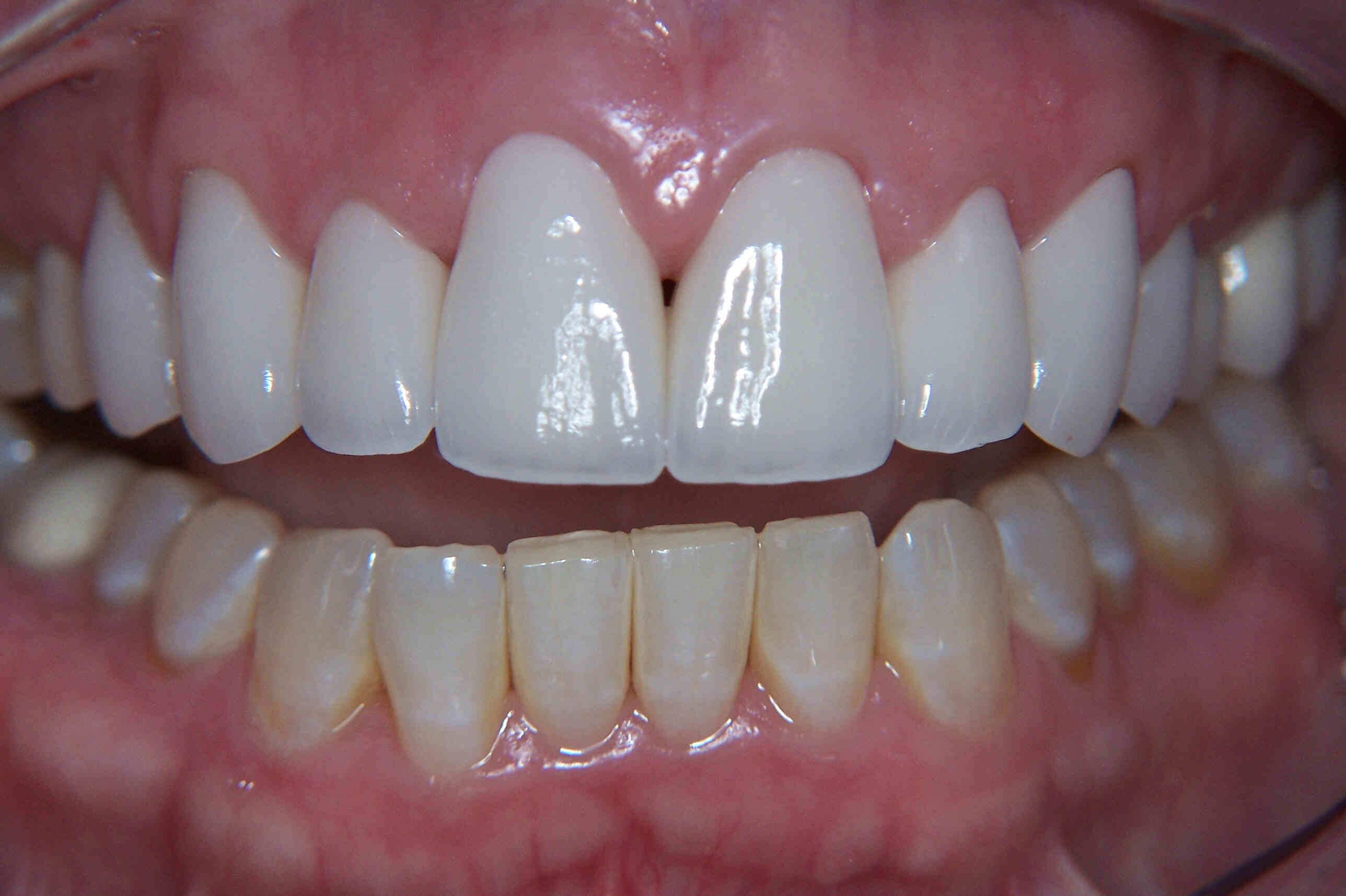 Dental Crowns Plano, TX Before & After Photos Gallery 47958 Dental Crowns Plano, TX Before & After Photos Gallery 47958