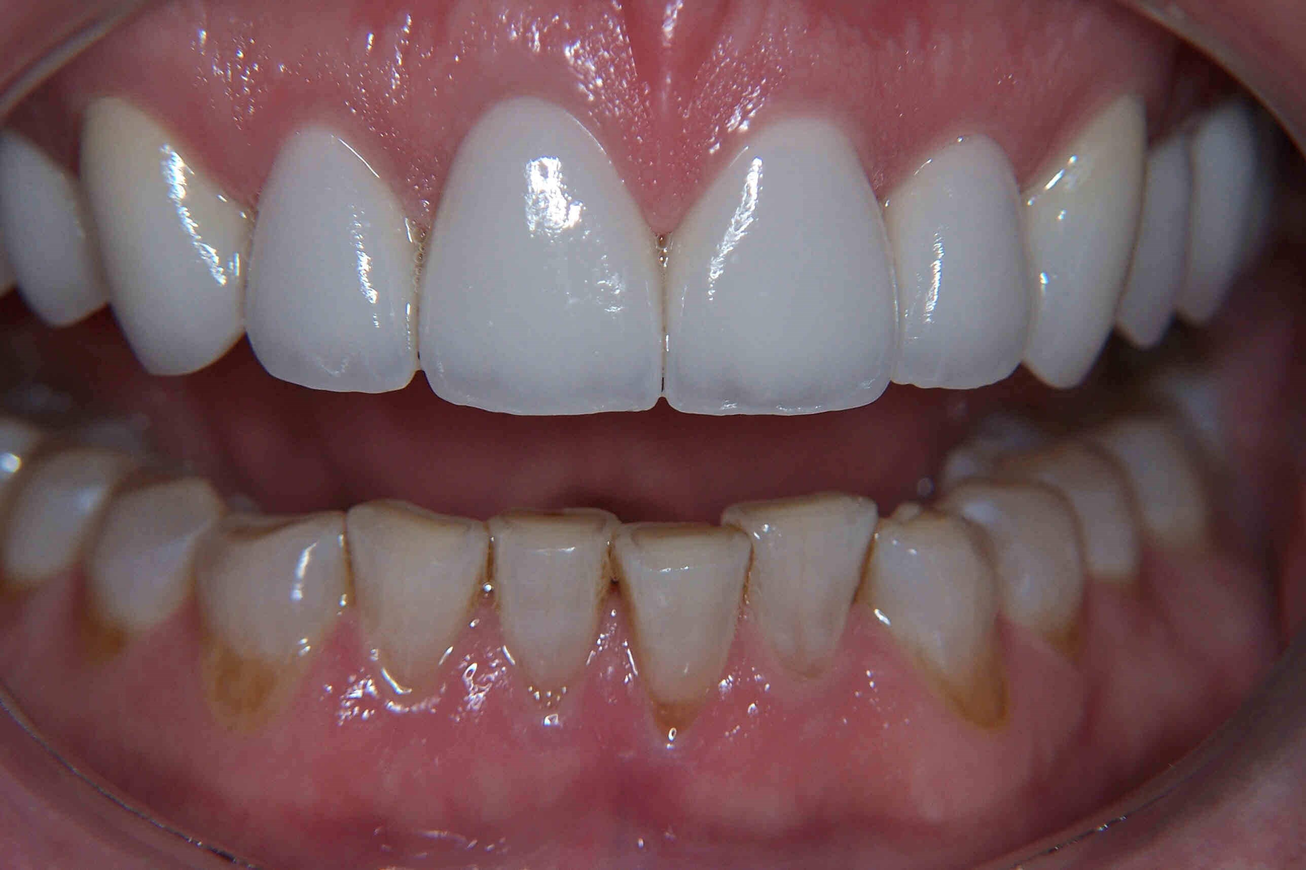 360 Veneers After