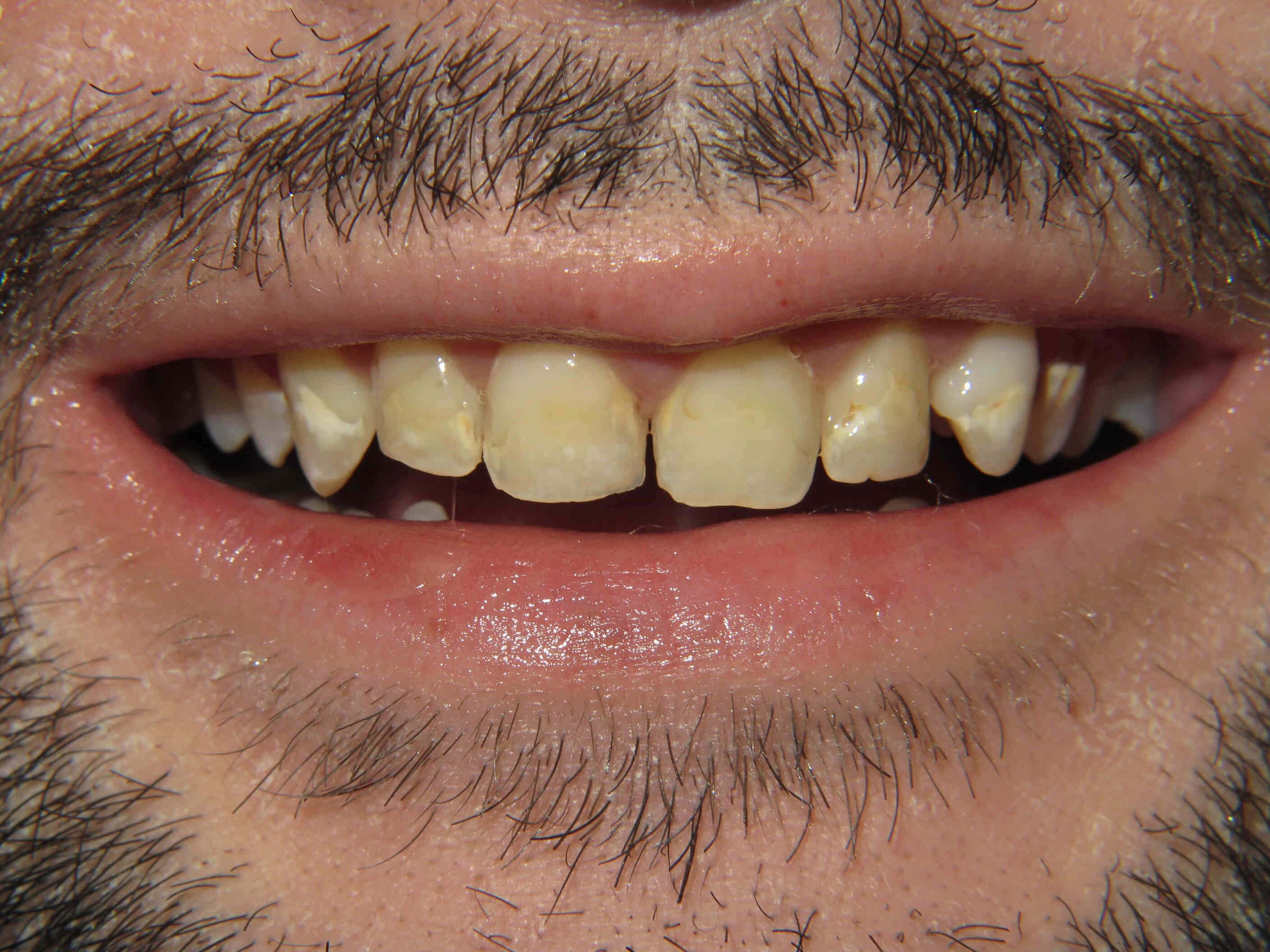 Smile Makeover Before