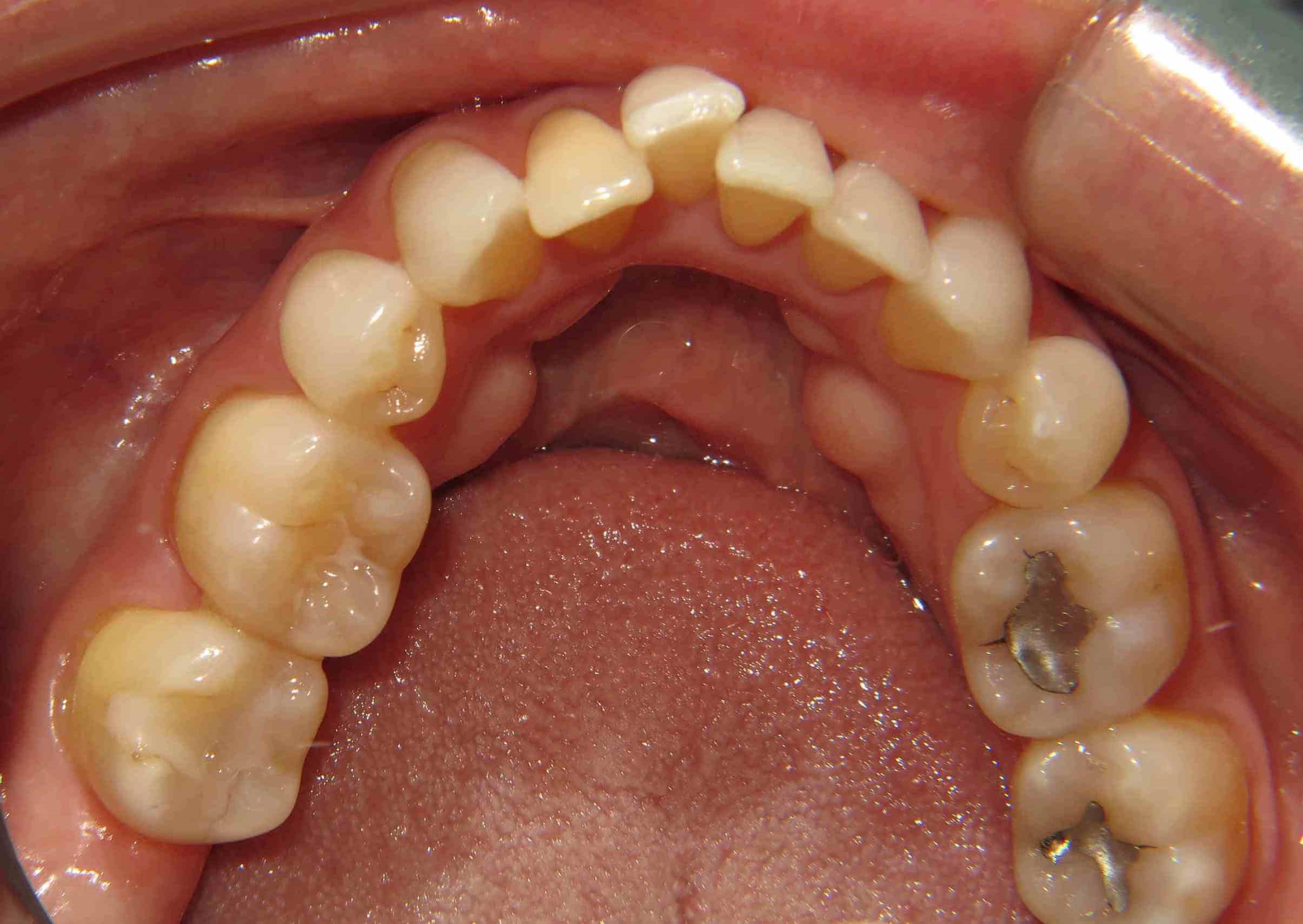 Clear Correct Case Before