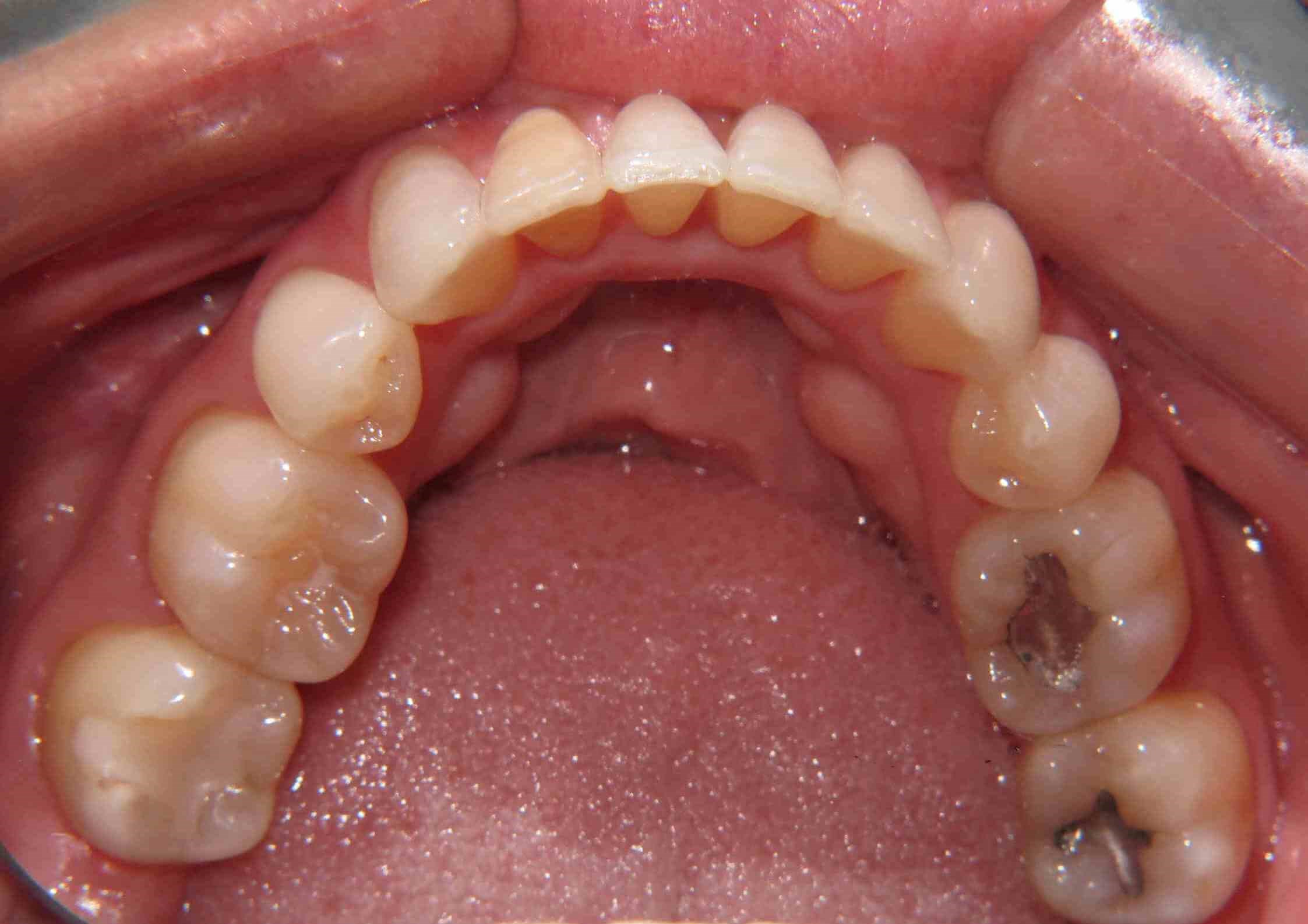 Clear Correct Case After