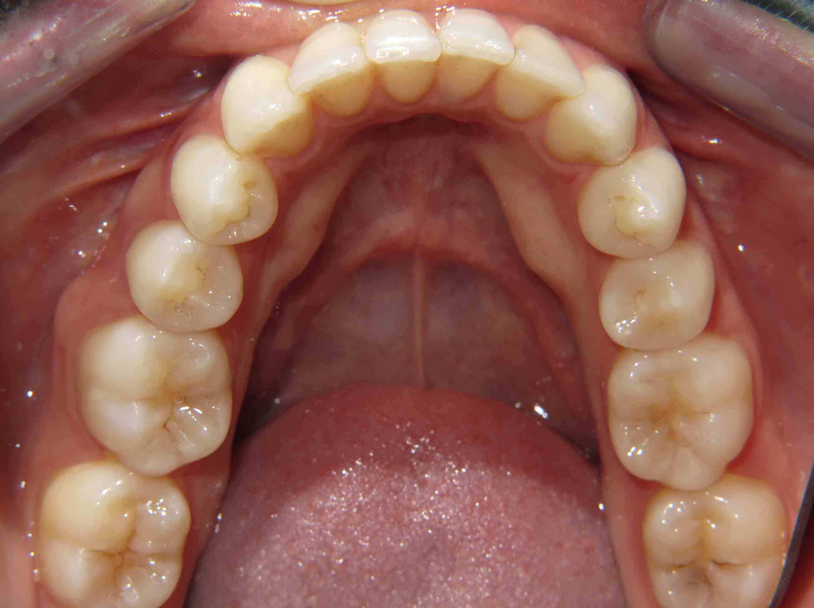 Clear Correct Case After