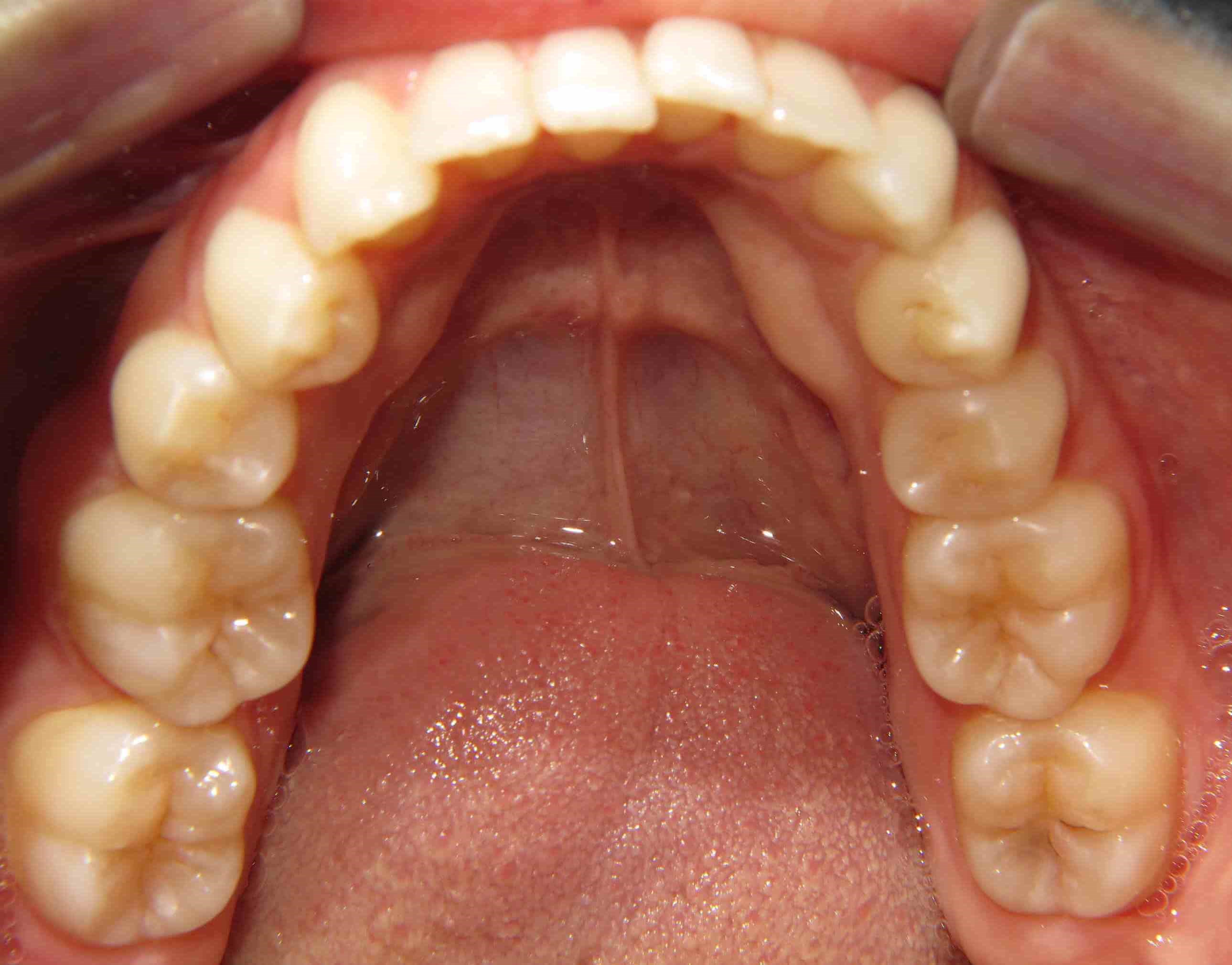 Clear Correct Case Before