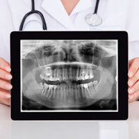 Digital X-rays